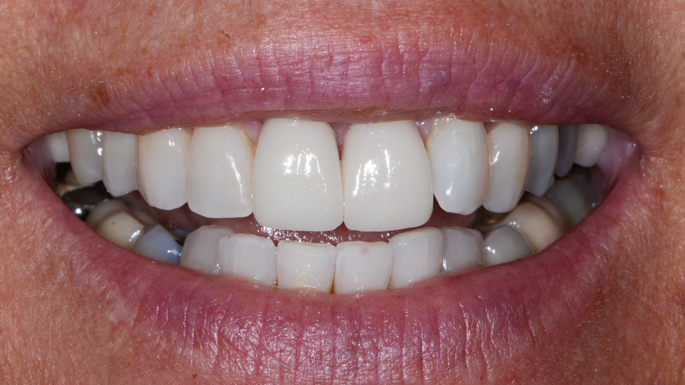 baxter dental clinic dental implants st louis post op