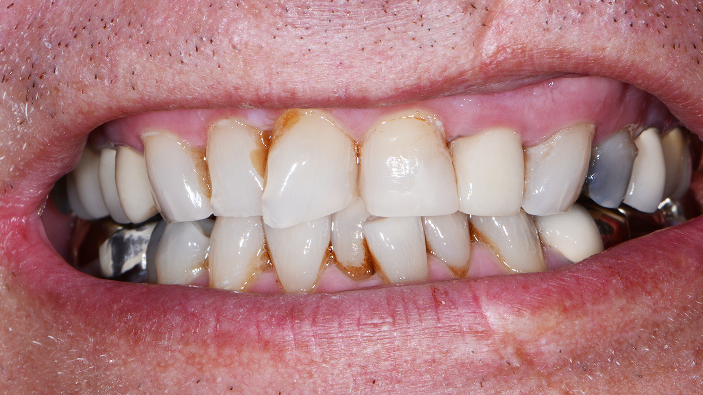 baxter dental clinic in office teeth whitening pre op