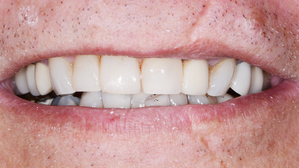 baxter dental clinic st louis teeth whitening post op