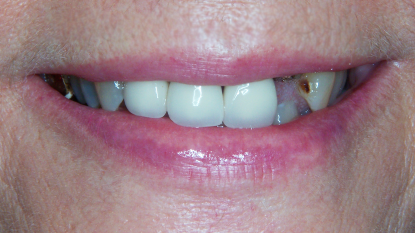 baxter dental group dental implants pre op