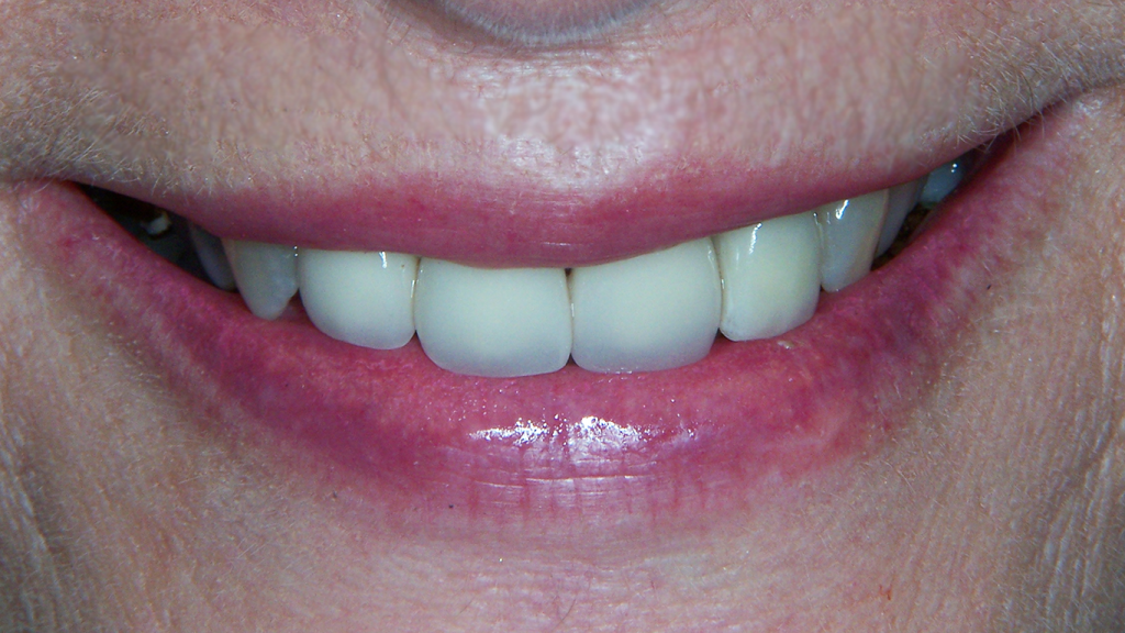 baxter dental group dental implants st louis post op