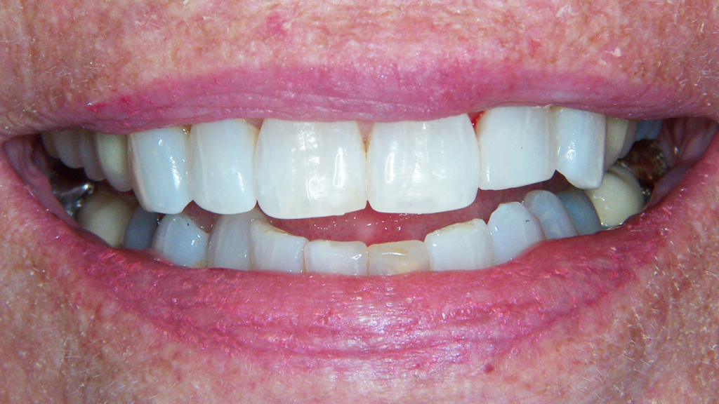 baxter dental group white fillings post op
