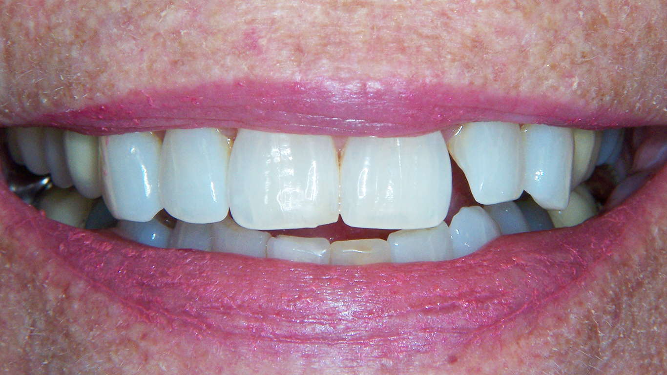 baxter dental group white fillings pre op