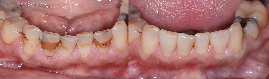 chipped teeth fillings featured image