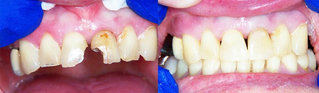 dental bonding featured image