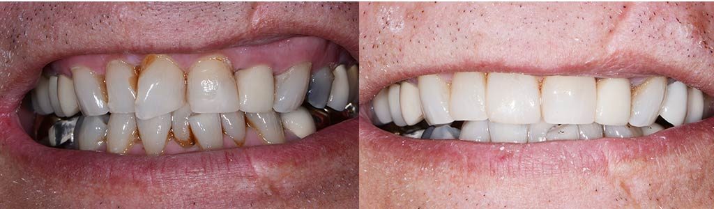 teeth whitening and fillings featured image