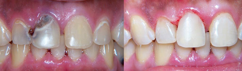 tooth decay featured image 1