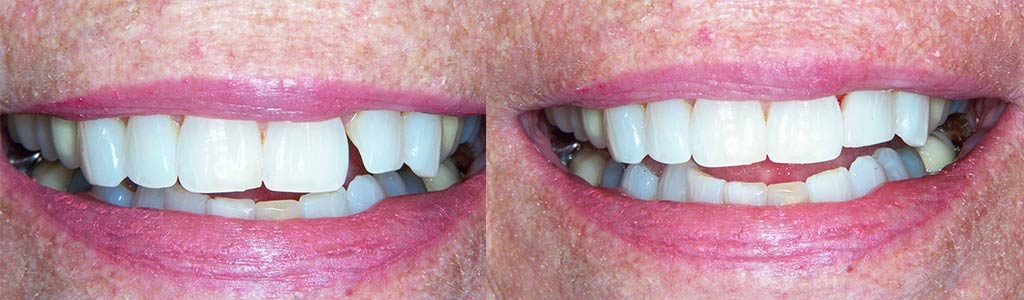 white fillings featured image